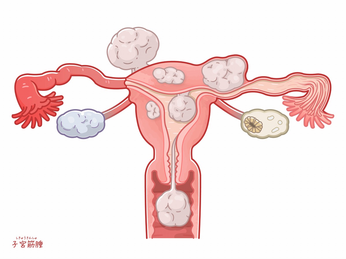 子宮筋腫の原因│吹田市の婦人科・たはらウィメンズクリニック│不妊治療・女性内科